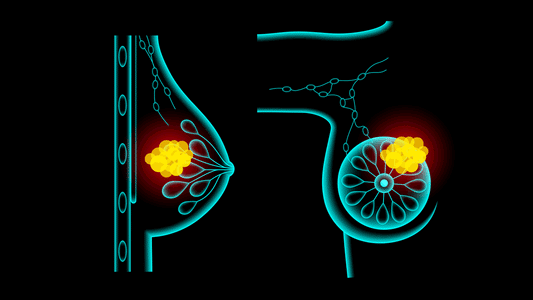 Lymph Dysfunction and its Role in Breast Cancer