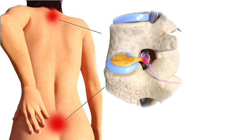 Herniated Disks
