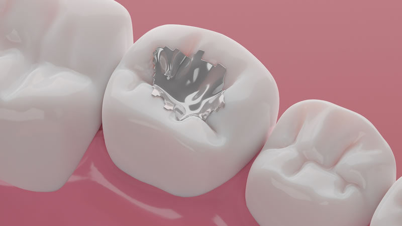 Toxic Effects of Dentistry